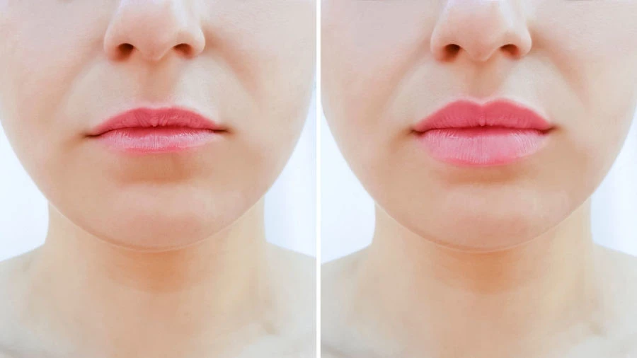 Resultados visibles Rejuvenecimiento facial duradero